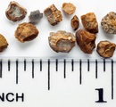 How Long Does it Take to Pass a Kidney Stone?