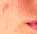 How to Get Rid of Acne?