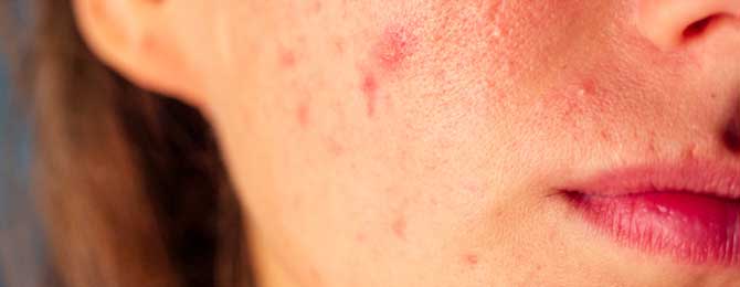 How to get rid of Acne?