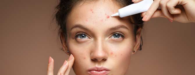 What Causes Acne?